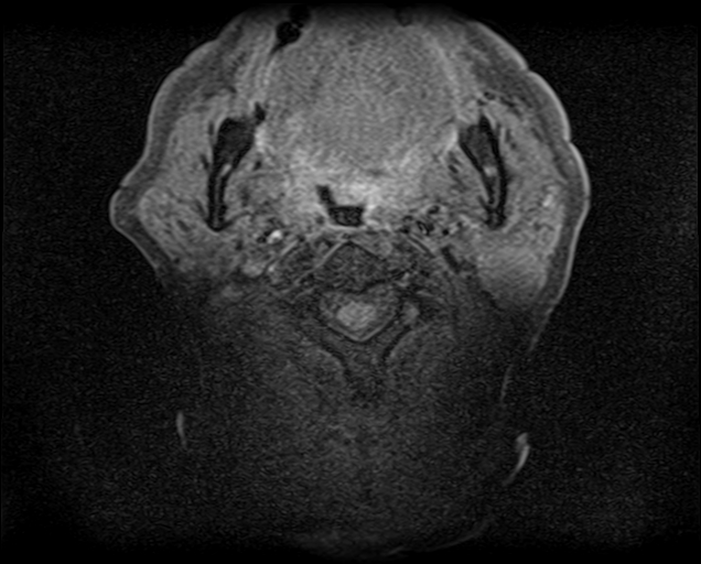 File:Non-Hodgkin lymphoma - parotid gland (Radiopaedia 71531-81890 T1 fat sat 11).jpg