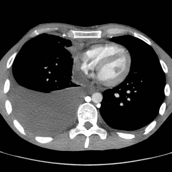 File:Non-Hodgkin lymphoma involving lung (Radiopaedia 29094-29470 B 45).jpg