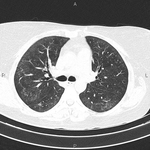 Non-specific interstitial pneumonia (Radiopaedia 83185-97567 Axial lung window 28).jpg