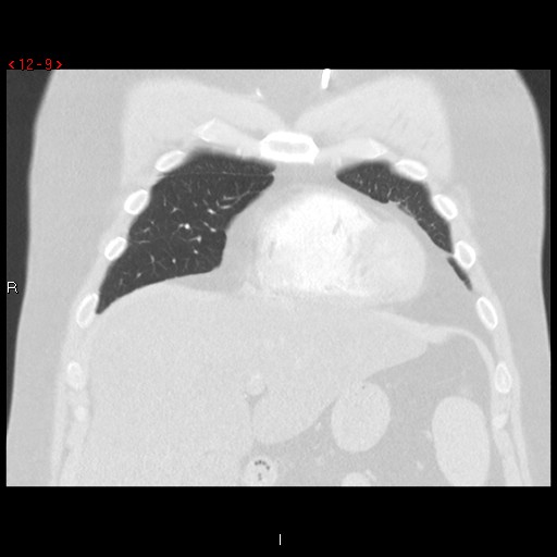 File:Non-specific interstitial pneumonitis (Radiopaedia 27044-27222 Coronal lung window 9).jpg