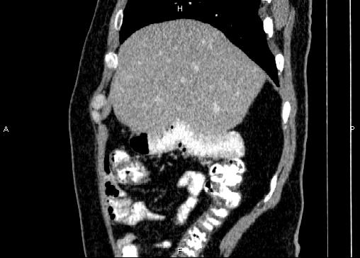 Non-syndromic pancreatic endocrine tumor (Radiopaedia 86958-103178 E 17).jpg