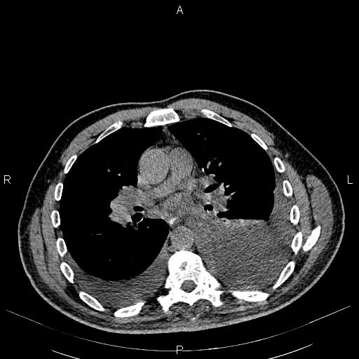 File:Non Hodgkin lymphoma in a patient with ankylosing spondylitis (Radiopaedia 84323-99621 Axial non-contrast 15).jpg