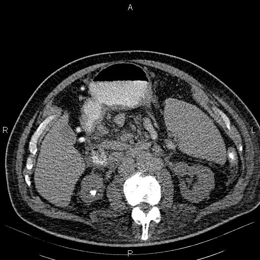 File:Non Hodgkin lymphoma in a patient with ankylosing spondylitis (Radiopaedia 84323-99621 Axial non-contrast 37).jpg