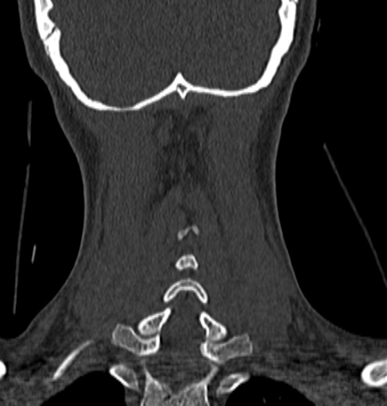 File:Normal CT cervical spine - 12-year-old (Radiopaedia 55352-61775 Coronal bone window 183).jpg