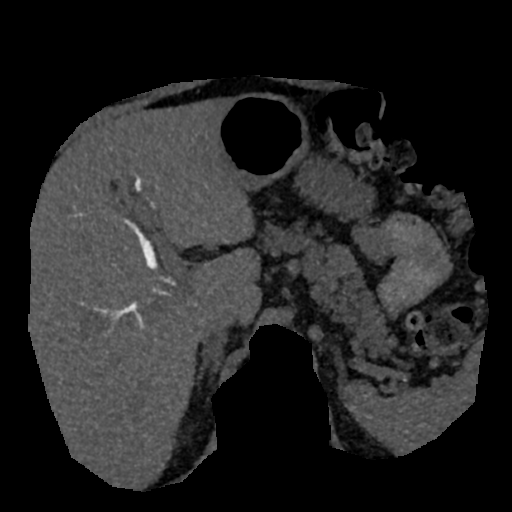 File:Normal CT intravenous cholangiogram (Radiopaedia 38199-40208 Axial IVC (MIP) 58).png