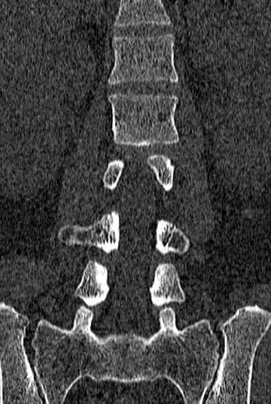 Normal CT lumbar spine (Radiopaedia 53981-60118 Coronal bone window 34).jpg