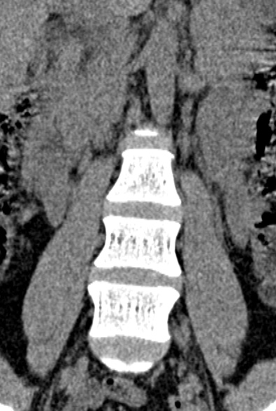 Normal CT lumbar spine (Radiopaedia 53981-60118 F 18).jpg