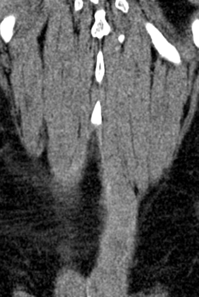 Normal CT lumbar spine (Radiopaedia 53981-60118 F 96).jpg