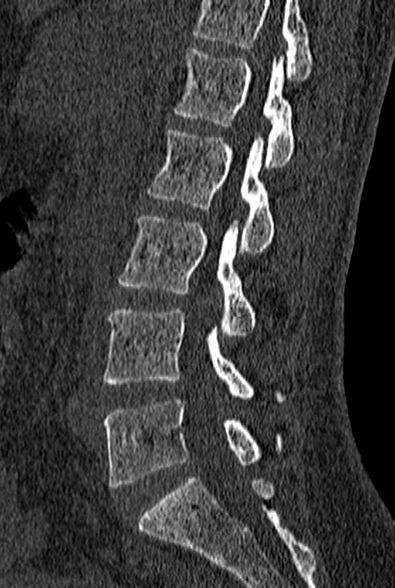 File:Normal CT lumbar spine (Radiopaedia 53981-60118 Sagittal bone window 42).jpg