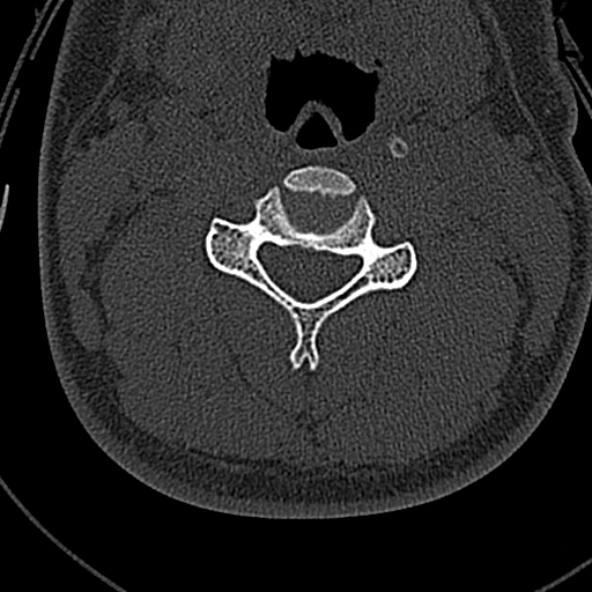 Normal CT of the cervical spine (Radiopaedia 53322-59305 Axial bone window 126).jpg