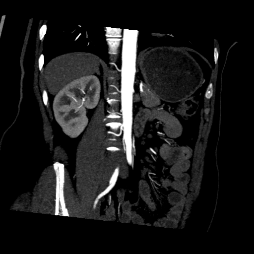 File:Normal CT renal artery angiogram (Radiopaedia 38727-40889 D 12).png