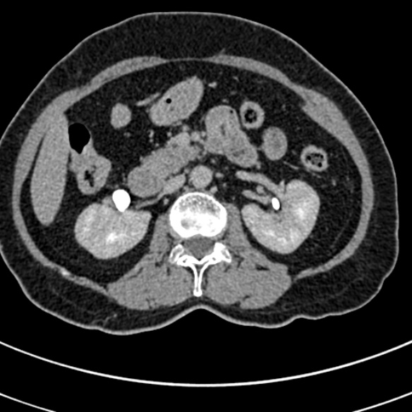 File:Normal CT split bolus study of the renal tract (Radiopaedia 48631-53634 Axial split bolus 78).jpg