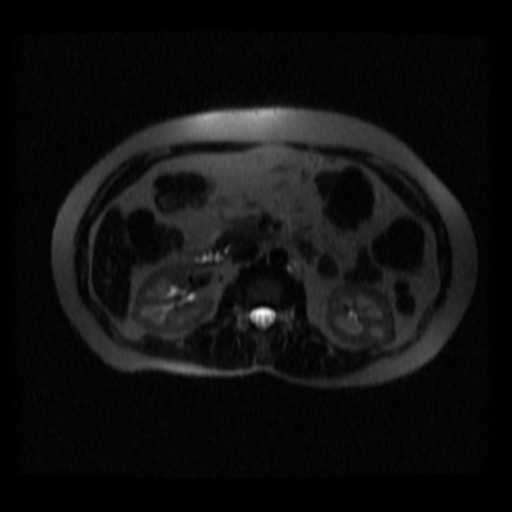 File:Normal MRCP (Radiopaedia 41966-44978 Axial T2 thins 8).png