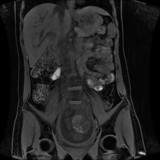 Normal MRI abdomen in pregnancy (Radiopaedia 88001-104541 M 74).jpg