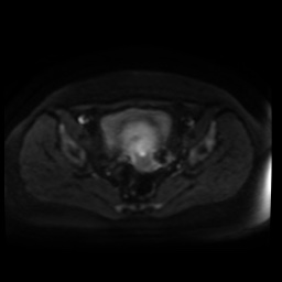 Normal MRI abdomen in pregnancy (Radiopaedia 88005-104548 Axial DWI 54).jpg