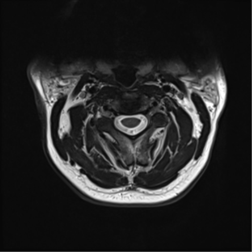 File:Normal MRI cervical spine (infection protocol) (Radiopaedia 53916-60039 Axial T2 17).png