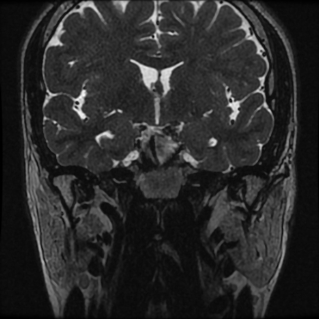 Normal MRI petrous (Radiopaedia 91317-108949 Coronal T2 17).jpg