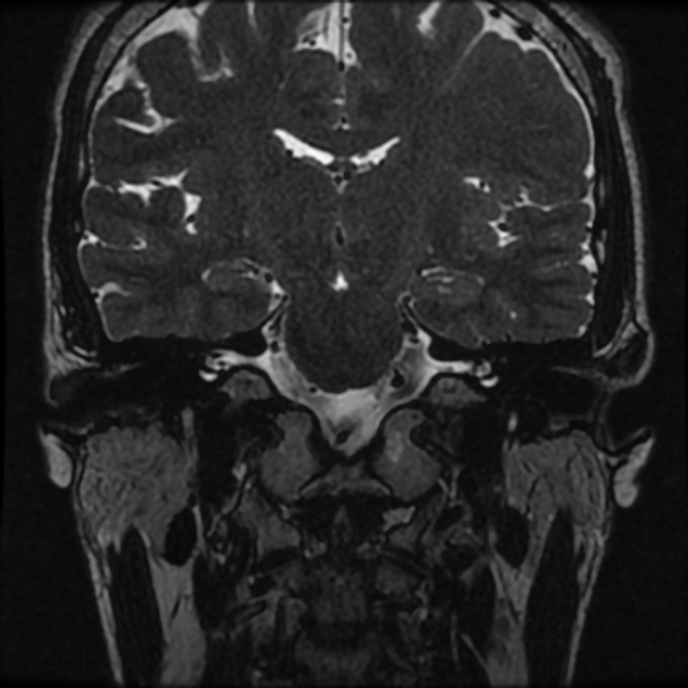 Normal MRI petrous (Radiopaedia 91317-108949 Coronal T2 43).jpg
