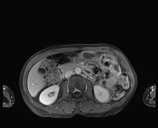 Normal adrenal glands MRI (Radiopaedia 82017-96004 M 44).jpg
