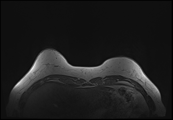 File:Normal breast MRI - dense breasts (Radiopaedia 80454-93850 Axial T1 28).jpg