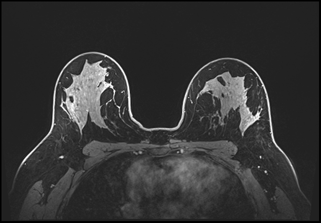 Normal breast MRI - dense breasts (Radiopaedia 80454-93850 C 137).jpg