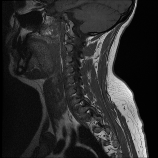 File:Normal cervical and thoracic spine MRI (Radiopaedia 35630-37156 Sagittal T1 3).png