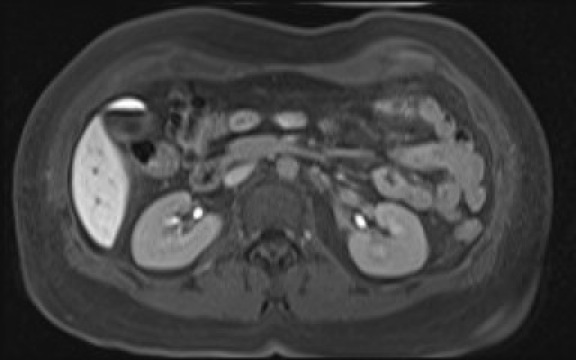 File:Normal hepatobiliary phase liver MRI (Radiopaedia 58968-66230 A 61).jpg