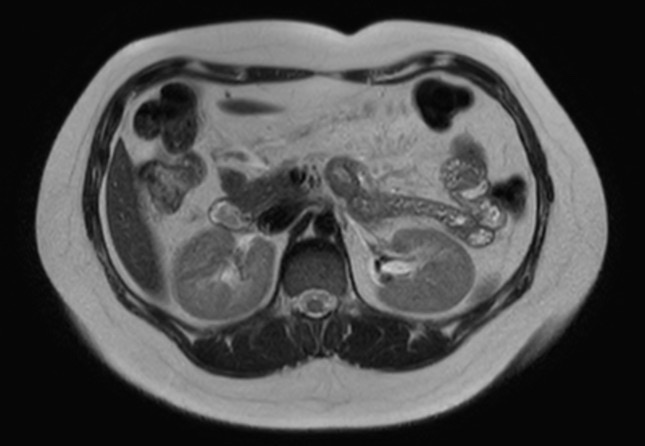 File:Normal liver MRI with Gadolinium (Radiopaedia 58913-66163 Axial T2 15).jpg