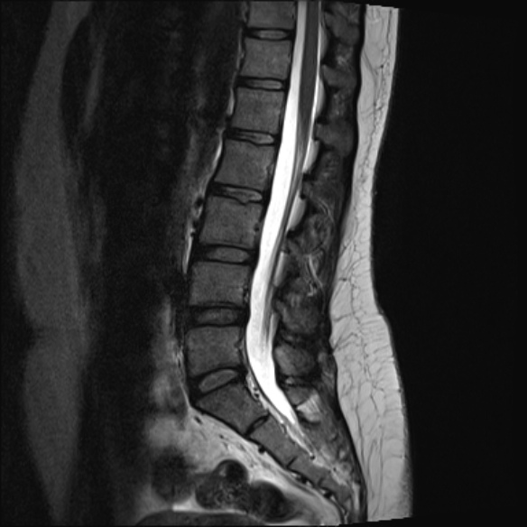 File:Normal lumbar spine MRI- 3 T (Radiopaedia 53280-59250 Sagittal T2 13).jpg
