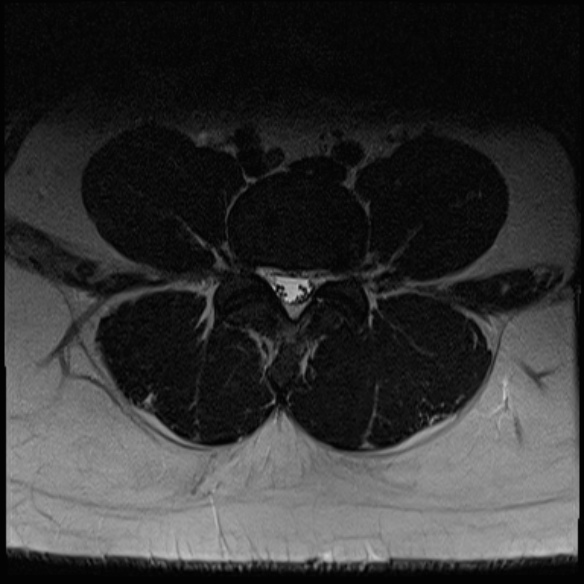 File:Normal lumbar spine MRI (Radiopaedia 47857-52609 Axial T2 19).jpg