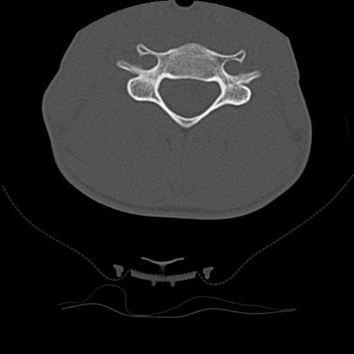 File:Normal trauma spine imaging (age 16) (Radiopaedia 45335-49358 Axial bone window 45).jpg