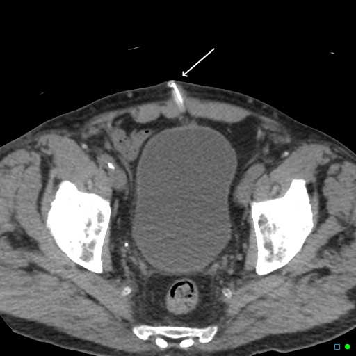 File:Obstructed Tenckhoff peritoneal dialysis catheter (Radiopaedia 37858-39789 Axial non-contrast 10).jpg