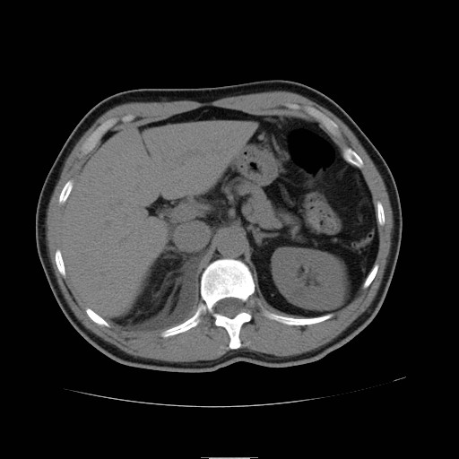 File:Obstructed kidney with perinephric urinoma (Radiopaedia 26889-27066 Axial non-contrast 10).jpg