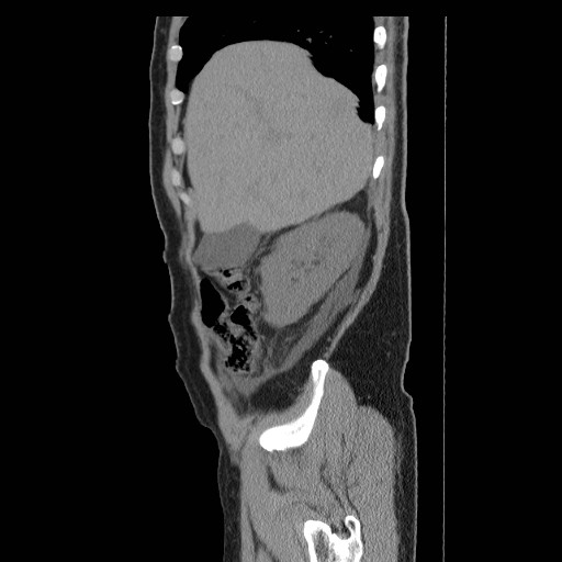 File:Obstructed kidney with perinephric urinoma (Radiopaedia 26889-27066 B 4).jpg