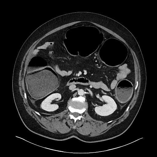 Obstructing sigmoid adenocarcinoma (Radiopaedia 58465-65619 A 69).jpg