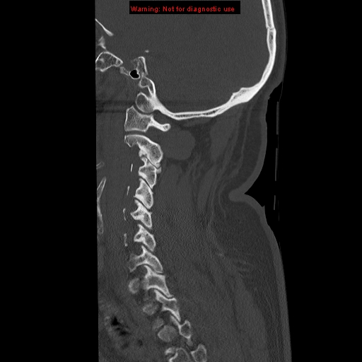 File:Occipital condyle fracture (Radiopaedia 18366-18208 Sagittal bone window 10).jpg
