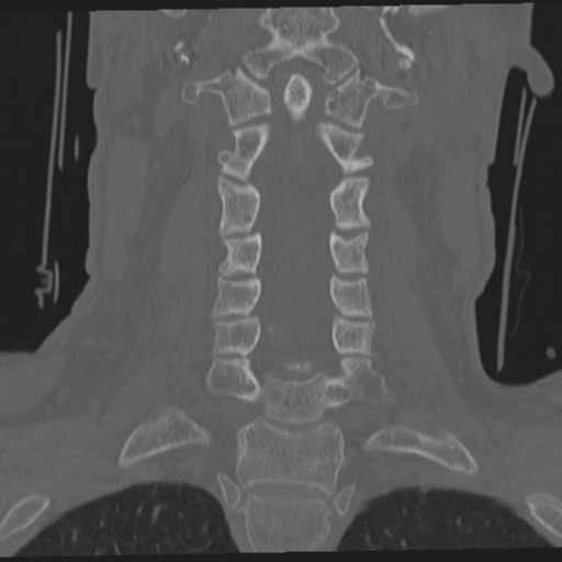 File:Occipital condyle fracture (Radiopaedia 33467-34517 Coronal bone window 32).png