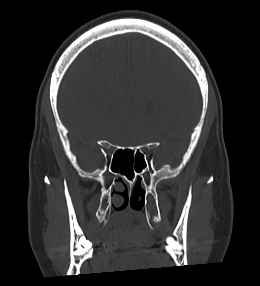 Occipital spur and Currarino type A atlas anomaly (Radiopaedia 87027-103285 Coronal bone window 62).jpg