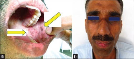 a) Hyperpigmentation in oral mucosa b)hyperpigmentation around the eyes, nose and early vitiligo over lips