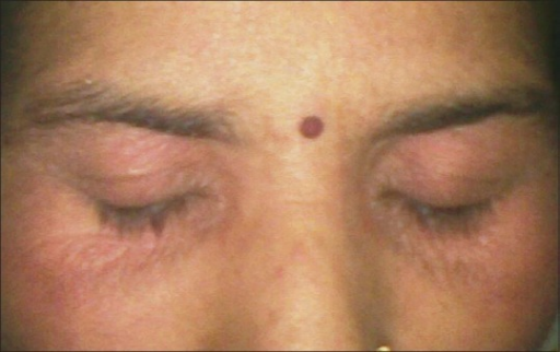 File:PPD contact dermatitis localized to eyelids.png