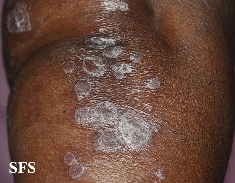 File:Psoriasis (Dermatology Atlas 49).jpg