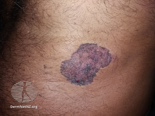 File:Superficial basal cell carcinoma (DermNet NZ basal-skin-of-colour-01).jpg