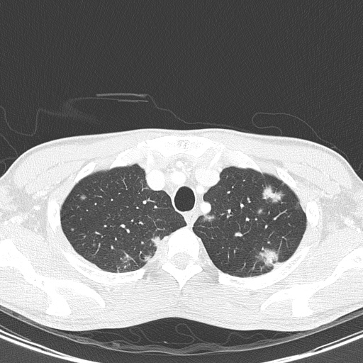 AIDS-related Kaposi sarcoma (Radiopaedia 85247-100811 Axial lung window 28).jpg
