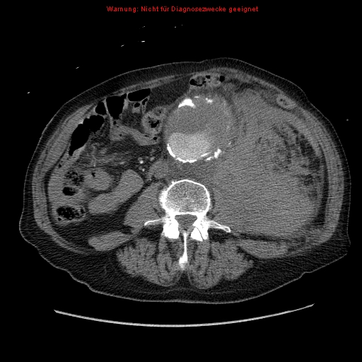 Abdominal aortic aneurysm- extremely large, ruptured (Radiopaedia 19882-19921 Axial C+ arterial phase 41).jpg