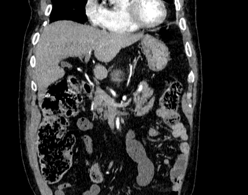 Abdominal aortic aneurysm (Radiopaedia 67117-76452 Coronal C+ arterial phase 19).jpg