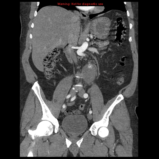 Abdominal aortic aneurysm (Radiopaedia 8190-9038 Coronal C+ arterial phase 67).jpg