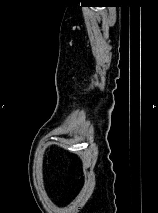 Abdominal aortic aneurysm (Radiopaedia 83094-97462 Sagittal renal cortical phase 121).jpg