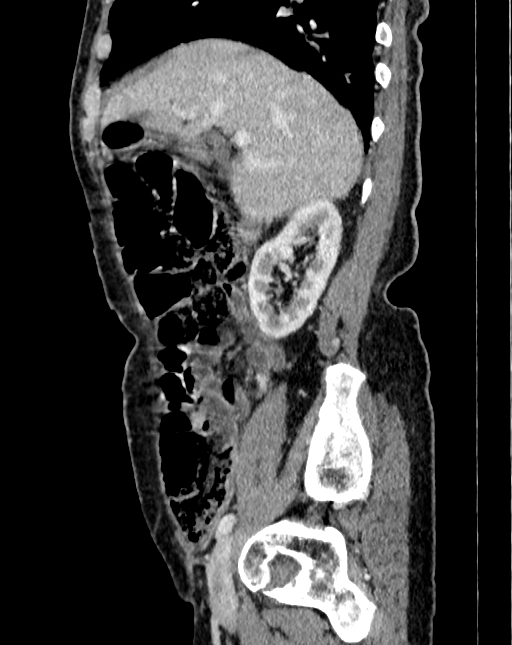 Abdominal aortic aneurysm (Radiopaedia 83581-98689 Sagittal C+ portal venous phase 2).jpg