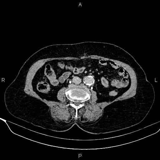 Abdominal aortic aneurysm (Radiopaedia 85063-100606 Axial C+ delayed 70).jpg