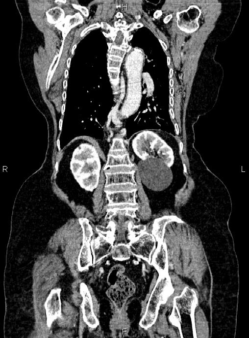 Abdominal aortic aneurysm (Radiopaedia 85063-100606 Coronal C+ arterial phase 42).jpg